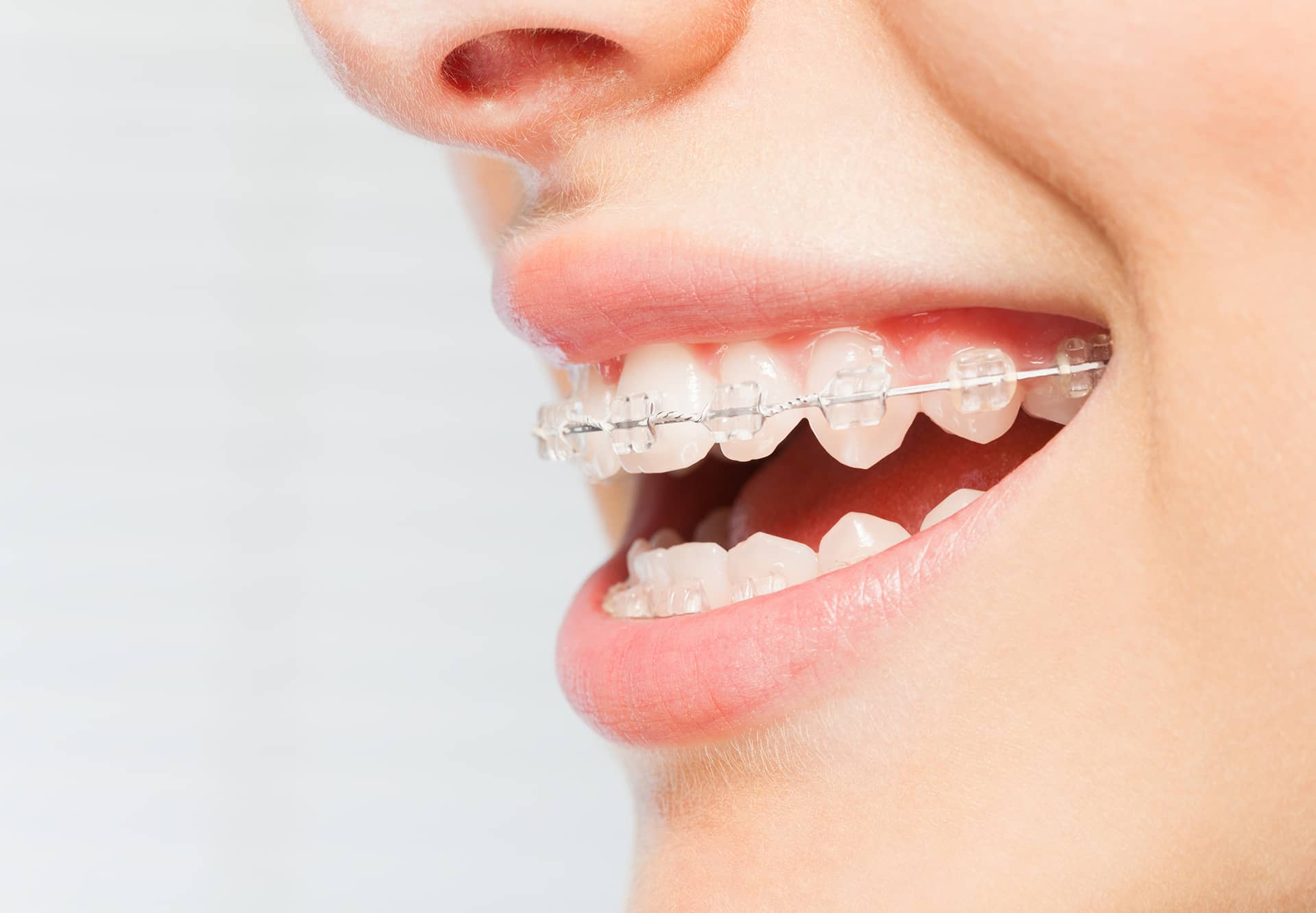 putting in clear braces